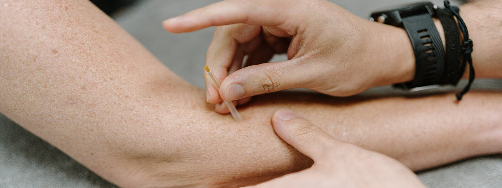 Understanding Dry Needling